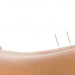 acupuncture in new york to lose weight is very effective